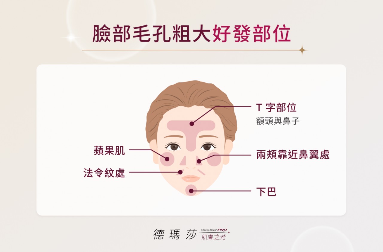 臉部毛孔粗大好發部位